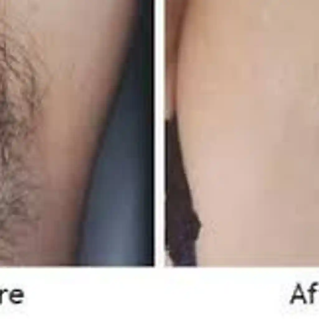 LASER HAIR REMOVAL